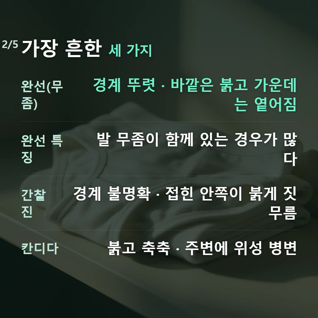 가장 흔한 세 가지 — 완선(무좀) 경계 뚜렷 · 바깥은 붉고 가운데는 옅어짐, 완선 특징 발 무좀이 함께 있는 경우가 많다, 간찰진 경계 불명확 · 접힌 안쪽이 붉게 짓무름, 칸디다 붉고 축축 · 주변에 위성 병변